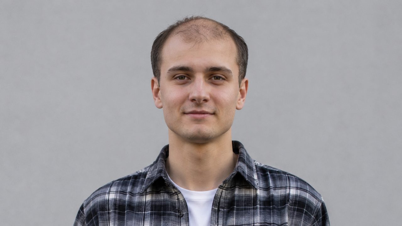 Редеющие волосы и залысины у висков до обработки нейросетью